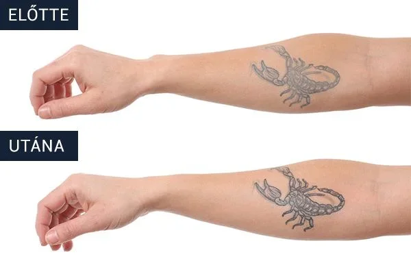 TATTOO NANO SHOCK Before After