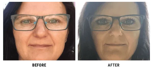 Annie Jones before and after using Lux-Factor 4D HYALYRON anti-wrinkle cream