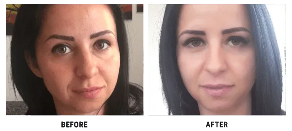 Nataly before and after 4D HYALYRON cream